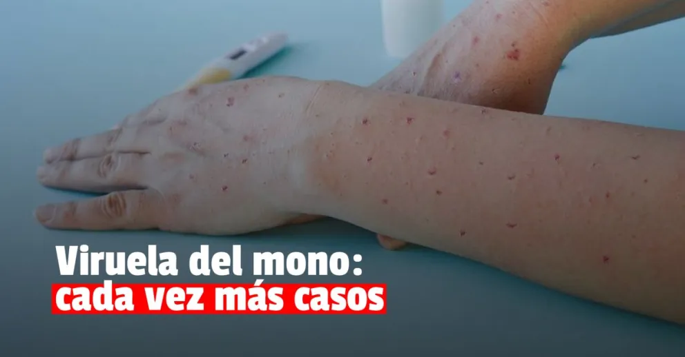 Aumentan los casos de viruela del mono en el país y llegan a 326