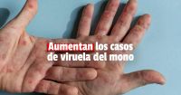 Anuncian 326 nuevos casos de viruela símica en Argentina