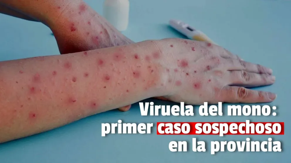Apareció el primer caso sospechoso de viruela del mono en San Juan 