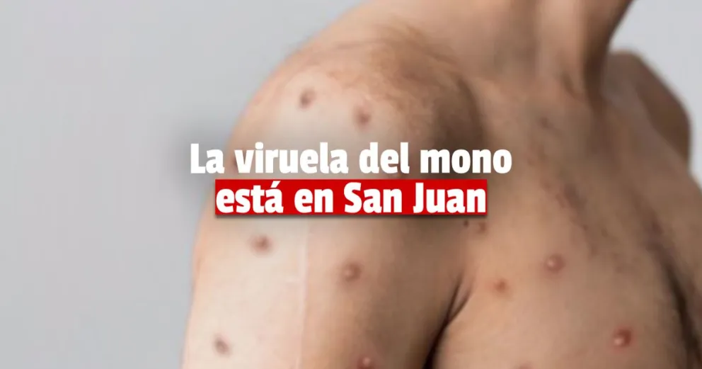 Urgente: confirman en San Juan el primer caso de viruela Símica