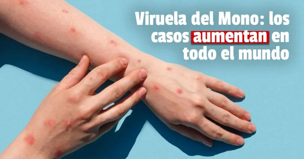 Viruela del mono: OMS confirmó más de 60 mil casos en el mundo
