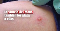Confirmaron el primer caso de viruela símica en un niño en Argentina