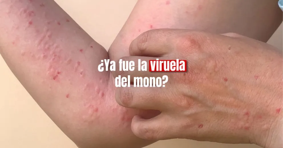 Afirman que la viruela del mono ya no es una emergencia sanitaria mundial